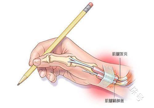 肌腱炎的症状有什么