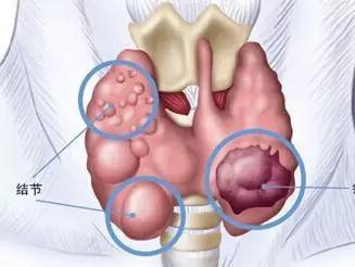 碘摄入量过多或者过少，有了甲状腺结节，该怎么摄入碘盐