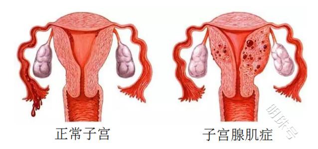 痛经严重难道就是子宫腺肌症吗？