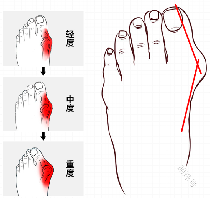 郝雨生：解析常见足部畸形——拇外翻