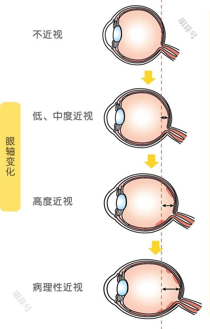 良好的视力将来是稀有资源，影响着就业生活各方面，叶黄素很关键