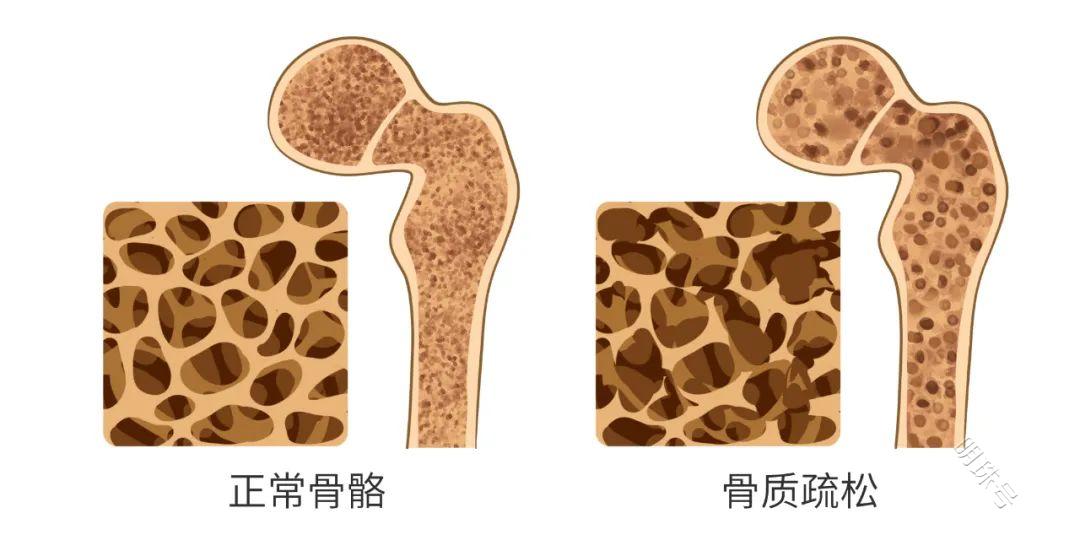 乳腺癌喜欢“啃”骨头，重视骨质疏松，为健康“骨”劲！