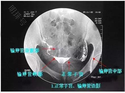 昆明送子鸟：输卵管积水怎么办？