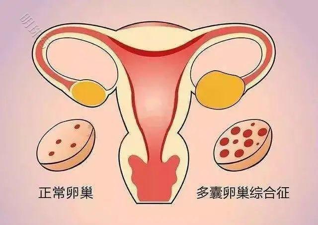 昆明送子鸟：多囊卵巢和多囊卵巢综合征可不一样，千万别搞混