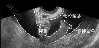 【昆明送子鸟问答】盆腔积液是什么？它会导