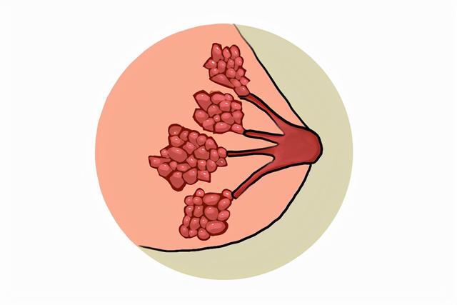 胸部摸到了硬块，会是乳腺癌吗？了解下吧