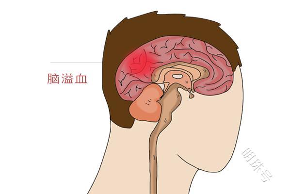 脑溢血是什么原因引发的？一起了解下吧
