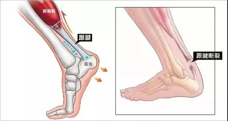 跟腱断裂术后康复治疗至关重要