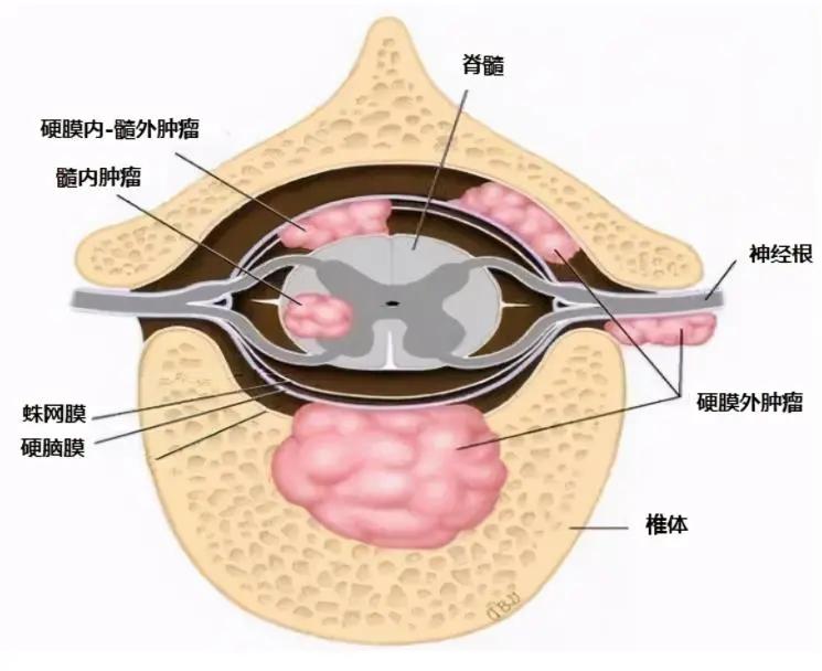 脊膜瘤是椎管内常见的肿瘤,起源于蛛网膜内皮细胞或硬脊膜的纤维细胞