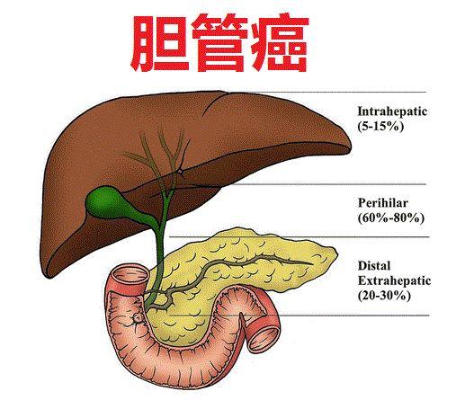 黄俭主任分享:胆管癌早期很像胆结石!出现这几个症状就要小心了