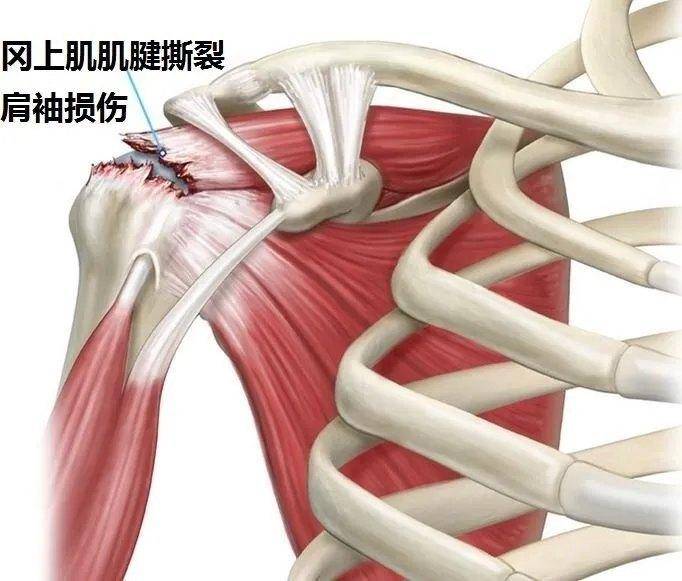 但80%的肩袖损伤可以通过保守治疗缓解疼痛