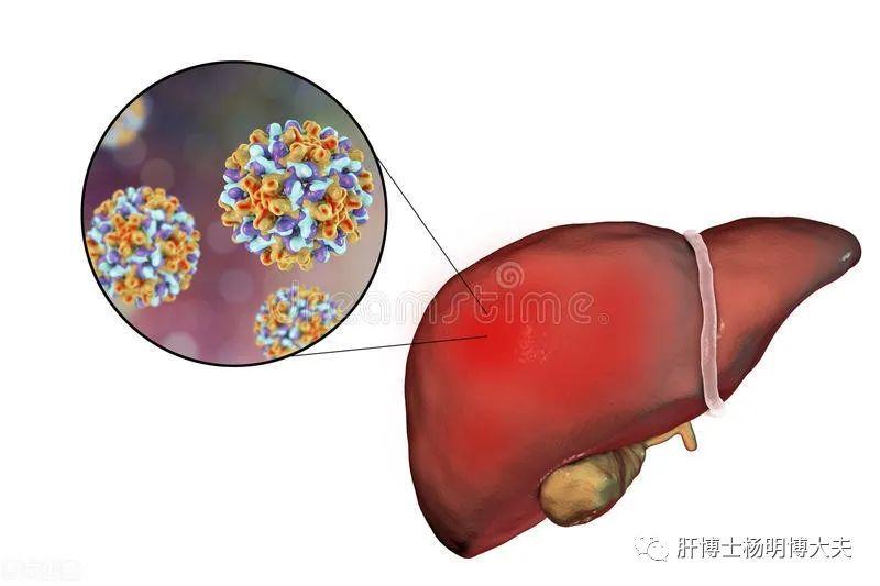 慢乙肝患者低病毒血症是怎么回事？