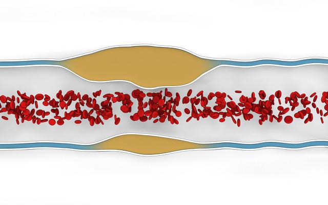 动脉斑块真的可以逆转或者消除吗？心血管医生来教你