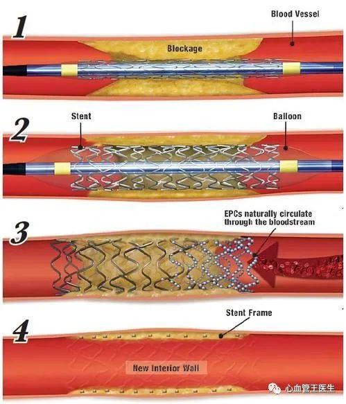 冠心病为什么放支架？支架的费用？支架的风险？支架的寿命？