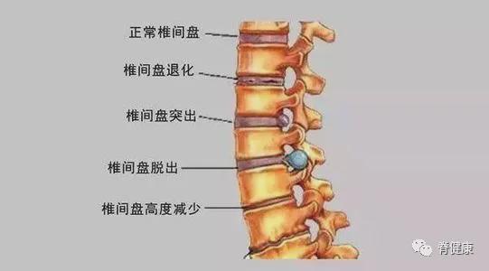 那些倒走治腰突的人后来都怎么样了?