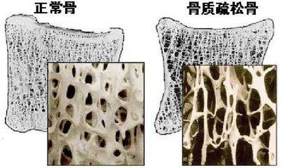 中科院士提醒除了老年人之外这3类人也容易患上骨质疏松