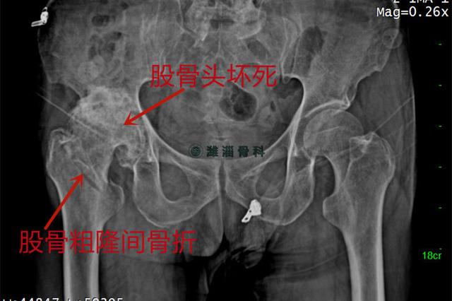 一台手术 新伤旧疾一并解决