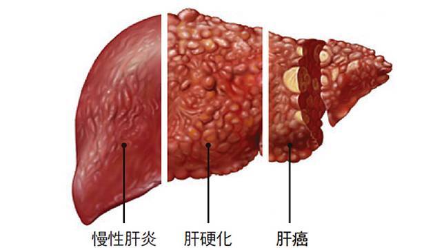 肝病变，牙齿先知？若牙齿出现这3个表现，建议：尽快去医院检查