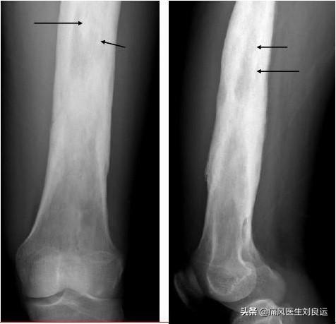 尿酸高加上关节肿痛就是痛风？这十种关节炎容易被误认为是痛风