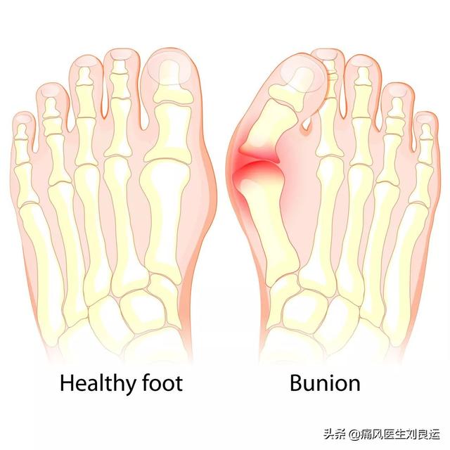 尿酸高加上关节肿痛就是痛风？这十种关节炎容易被误认为是痛风