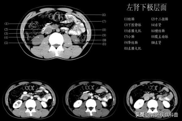 快速掌握——腹部CT