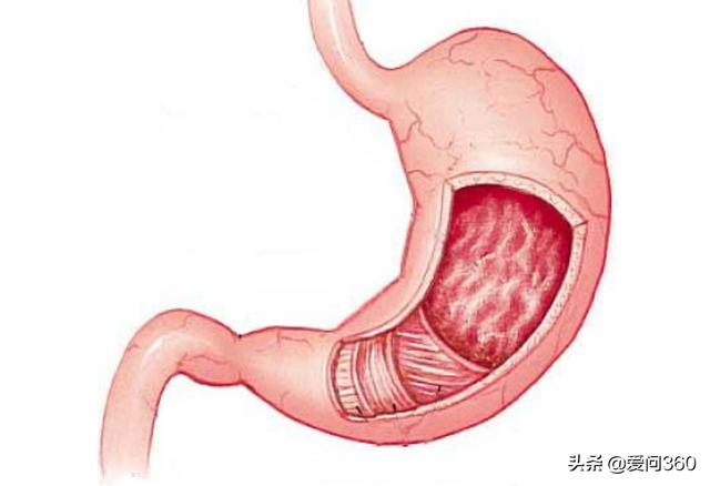 胃黏膜是保护胃部的一道屏障修复胃黏膜的方法要学会用