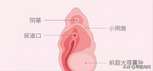 前庭大腺囊肿主要表现为一侧阴唇较另一侧肿大，开始大阴唇后1/3处发现红