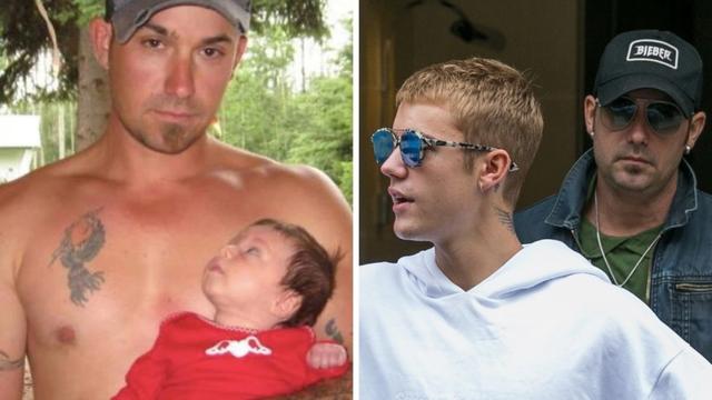 Justin Bieber 脂溢性脱发，有秃顶的前兆了…