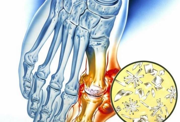 控制尿酸、防痛风“从嘴开始”，这四类食物，再喜欢也要尽量少碰