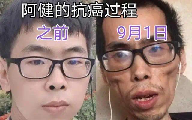 34岁博主患肠癌离世，一年时间瘦成骷髅！4个习惯易招癌，赶紧改