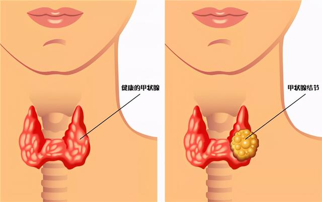 甲状腺结节不可以吃鸡蛋？提醒：若想结节“消散”，这3物要忌口