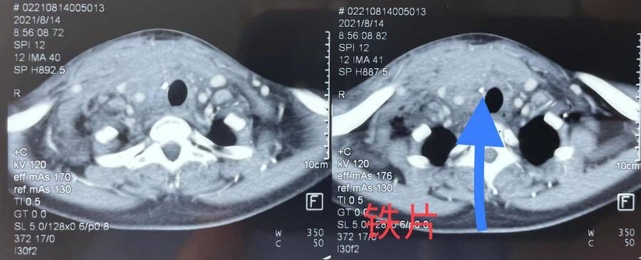 与时间赛跑！金属异物嵌顿气管刺破动脉 省耳鼻喉医院紧急施救