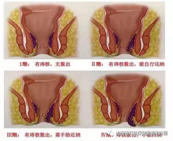 不开刀治痔疮,内痔微创治疗新方法