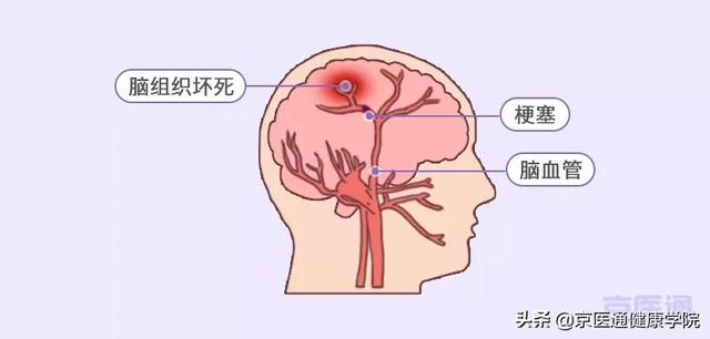 安贞心内大咖说 | 经常心慌的人需警惕脑梗的风险