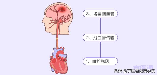 安贞心内大咖说 | 经常心慌的人需警惕脑梗的风险