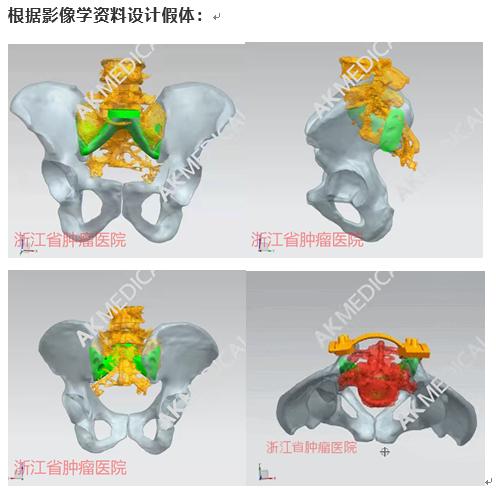 切了复发的肿瘤就会少块骨头：浙江首例3D打印全骶骨手术给他“换新骨”