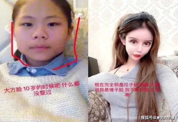 还记得花百万整容的13岁女孩吗？3年整了100次，如今前后判若两人