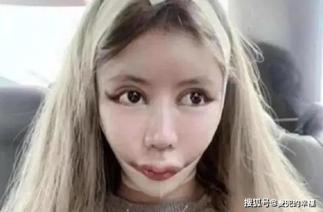 还记得花百万整容的13岁女孩吗？3年整了100次，如今前后判若两人