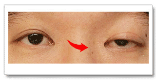 济南海峡整形科普:双眼皮为什么要做上睑提肌?