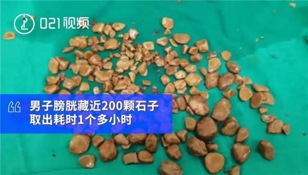 男子患膀胱结石身体藏近200颗重量达195克