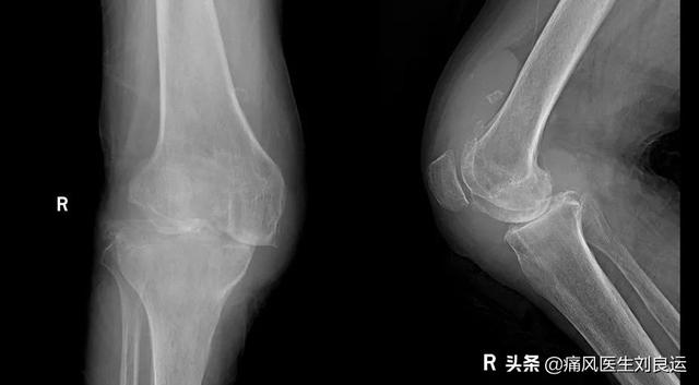 男子三伏天怕冷开电热毯，被诊断为痛风两年后医生说他被误诊