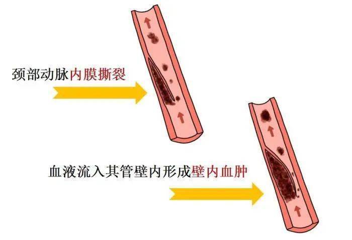 运动健身、拔火罐、“种草莓”……会得脑中风？