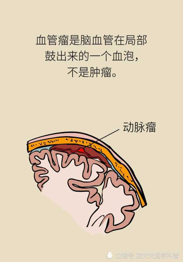 脑动脉瘤究竟是咋回事儿？