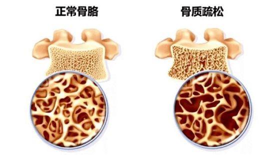 骨头变脆，腰部先知？医生：若是腰部出现这一情况，或是骨松“到访”