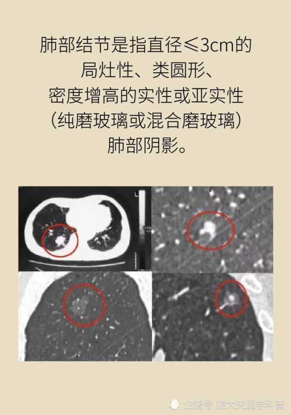 长了肺结节如何尽早确定手术还是观察？神奇的1024靶扫描了解一下