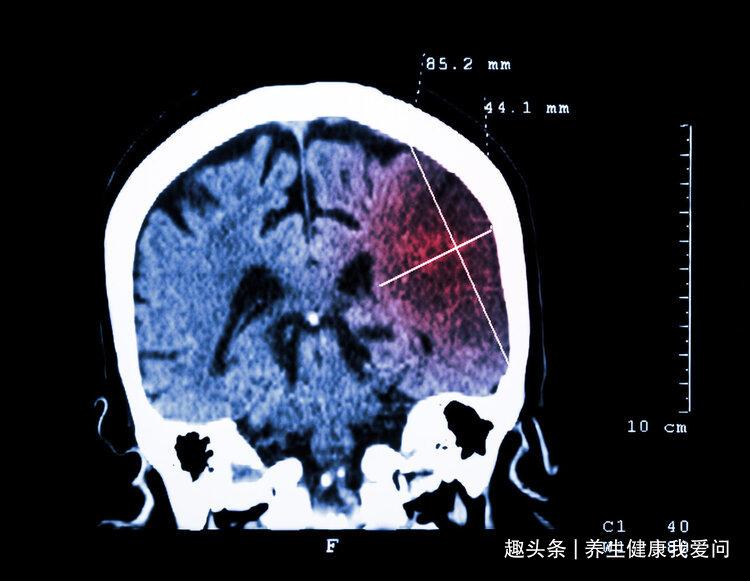 为什么中国脑梗越来越多？除了饮食外，这2点或也是脑梗“帮凶”