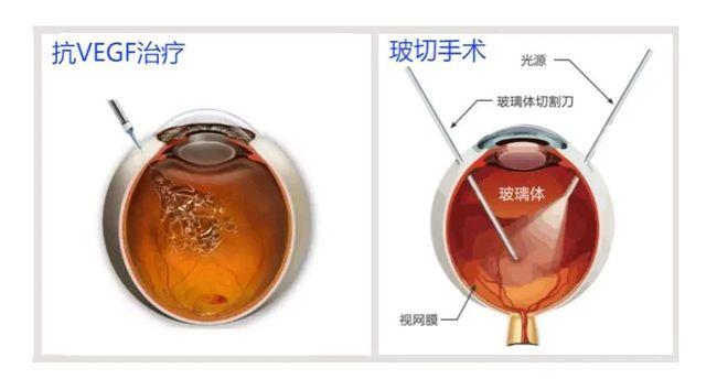 热点关注 | 确诊糖尿病一定要看眼科吗？