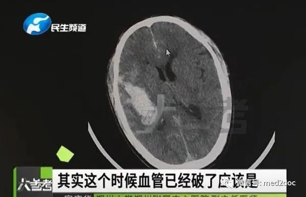 上厕所太用力！一男子上完后头痛2天，就医时发现脑出血，差点丧命……