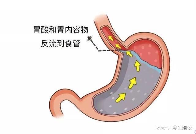 胃食管反流病，会导致癌变吗？