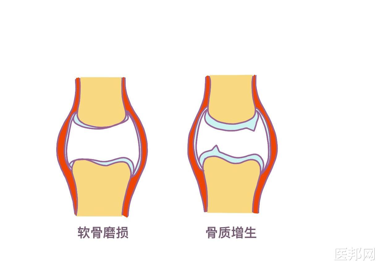 天气变冷，关节炎频繁发作怎么办？骨关节炎的10大误区你知道吗？